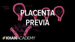 Placenta previa | Reproductive system physiology | NCLEX-RN | Khan Academy