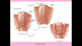 Postpartum Hemorrhage – CRASH! Medical Review Series