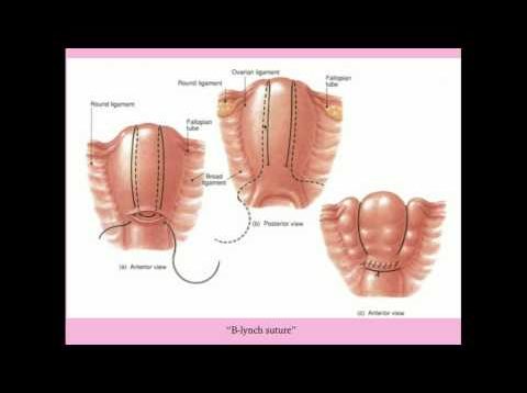Postpartum Hemorrhage – CRASH! Medical Review Series