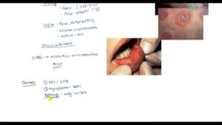 Steven Johnson Syndrome (SJS), Toxic Epidermal Necrolysis (TEN) and Erythema multiforme for USMLE