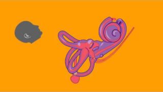 Understand BPPV in One Minute – Michael Teixido, M.D.