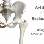 Artificial Hip Replacement – Anterior Approach