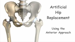 Artificial Hip Replacement – Anterior Approach