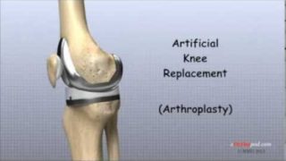 Artificial Knee Replacement