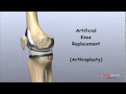 Artificial Knee Replacement