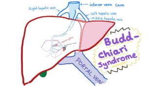 Budd-Chiari syndrome (Def., causes, pathophysiology, Dx& ttt)