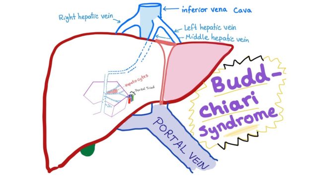 Budd-Chiari syndrome (Def., causes, pathophysiology, Dx& ttt)