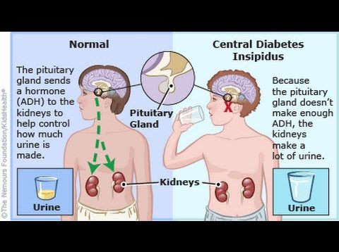 Central Diabetes Insipidus