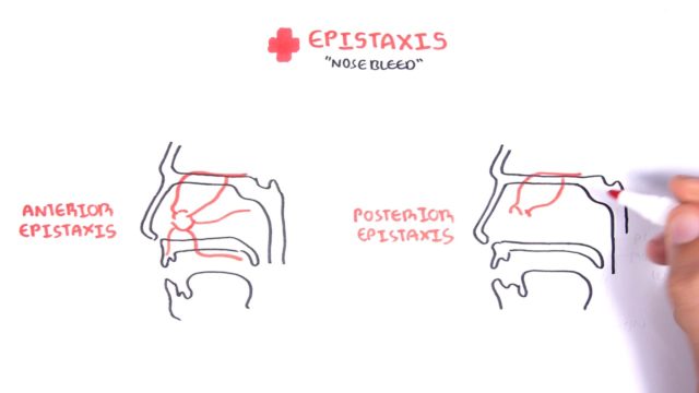 Clinical Anatomy - Nasal Cavity And Nose Bleeds - 2023