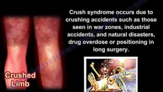 Crush Syndrome – Everything You Need To Know – Dr. Nabil Ebraheim
