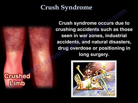 Crush Syndrome - Everything You Need To Know - Dr. Nabil Ebraheim - 2023