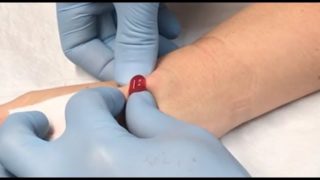 ganglion cyst drainage