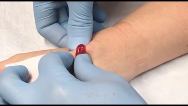 ganglion cyst drainage