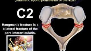 Hangman’s Fracture, C2 Fracture – Everything You Need To Know – Dr. Nabil Ebraheim
