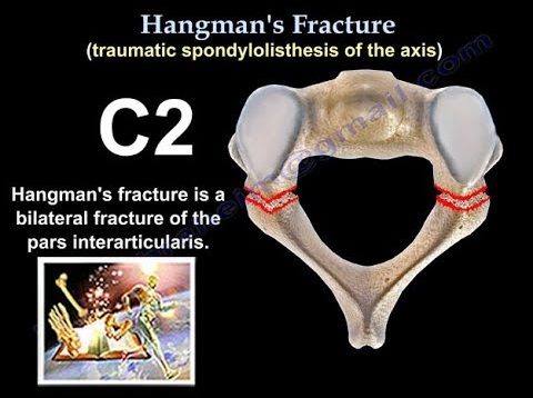 Hangman’s Fracture, C2 Fracture – Everything You Need To Know – Dr. Nabil Ebraheim