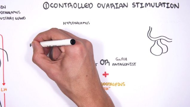 In Vitro Fertilization (IVF) – Overview