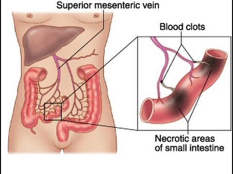 Mesenteric Ischemia