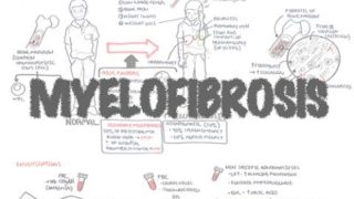 Myelofibrosis (DETAILED) Overview