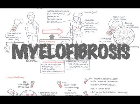 Myelofibrosis (DETAILED) Overview