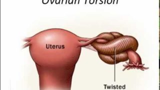 ovarian torsion
