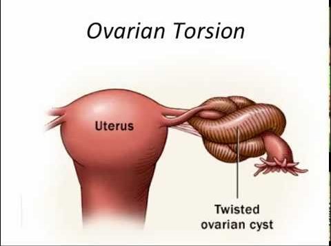 ovarian torsion