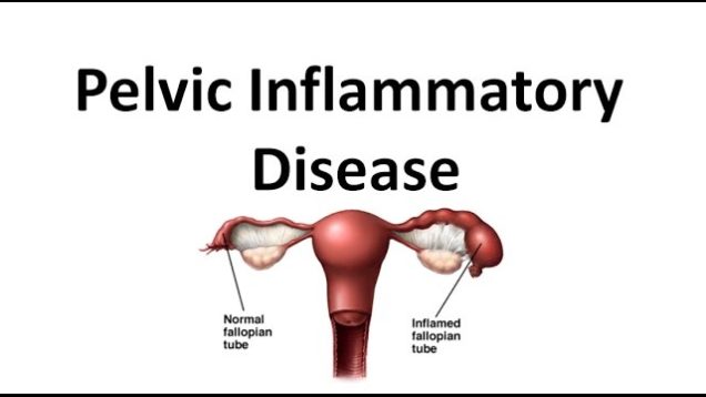 Pelvic Inflammatory Disease (PID)