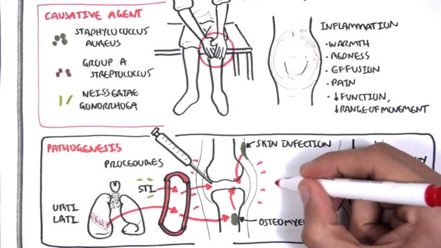 Septic Arthritis – Overview