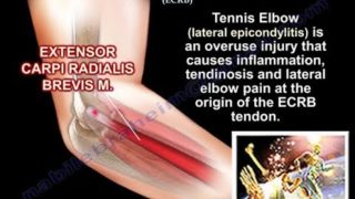 Tennis Elbow Extensor Carpi Radialis Brevis, Everything You Need To Know – Dr. Nabil Ebraheim