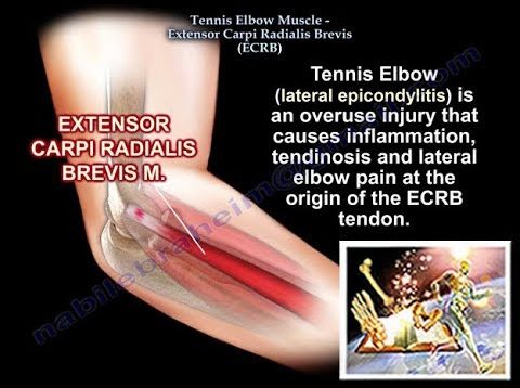 Tennis Elbow Extensor Carpi Radialis Brevis, Everything You Need To Know – Dr. Nabil Ebraheim