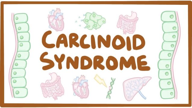Carcinoid Syndrome – causes, symptoms, diagnosis, treatment, pathology