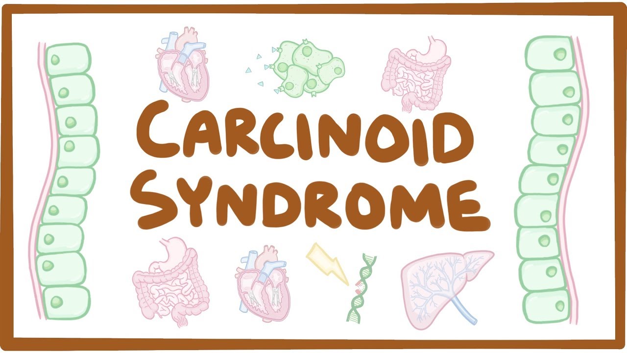 carcinoid-syndrome-causes-symptoms-diagnosis-treatment-pathology