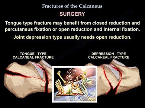 Fractures Of The Calcaneus – Everything You Need To Know – Dr. Nabil Ebraheim
