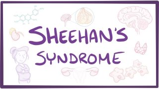 Sheehan’s Syndrome – causes, symptoms, diagnosis, treatment, pathology