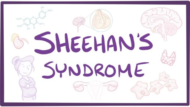 Sheehan’s Syndrome – causes, symptoms, diagnosis, treatment, pathology