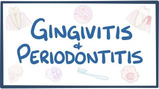 Gingivitis and periodontitis – causes, symptoms, diagnosis, treatment, pathology