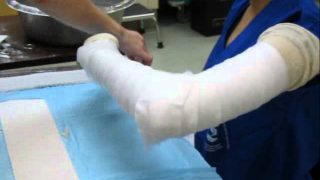 Long Arm Splint