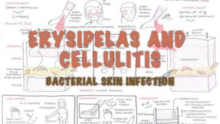 Bacterial Skin Infection – Cellulitis and Erysipelas (Clinical Presentation, Pathology, Treatment)