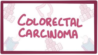 Colorectal carcinoma – causes, symptoms, diagnosis, treatment, pathology
