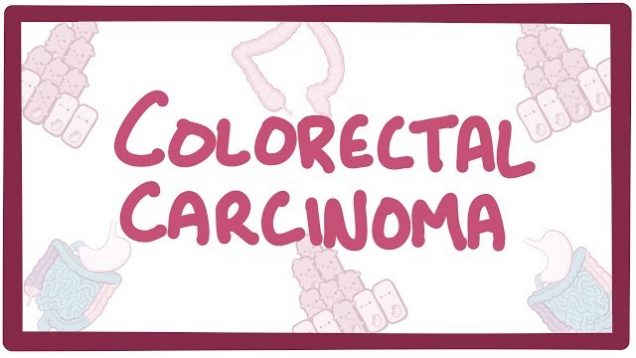 Colorectal carcinoma – causes, symptoms, diagnosis, treatment, pathology