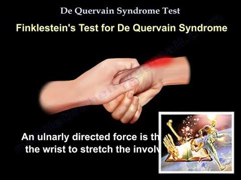 De Quervain Syndrome Test – Everything You Need To Know – Dr. Nabil Ebraheim