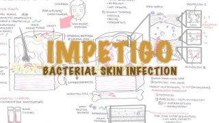 Impetigo Bacterial Skin Infection – Overview (Clinical Presentation, Pathophysiology, Treatment)
