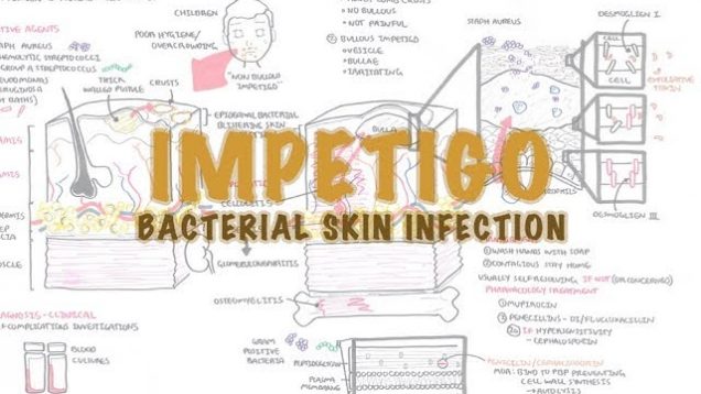 Impetigo Bacterial Skin Infection – Overview (Clinical Presentation, Pathophysiology, Treatment)