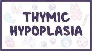 Thymic hypoplasia – causes, symptoms, diagnosis, treatment, pathology