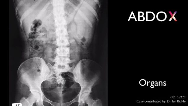 ABDO X – approach to abdominal x-ray interpretation