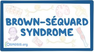 Brown-Séquard syndrome – causes, symptoms, diagnosis, treatment, pathology