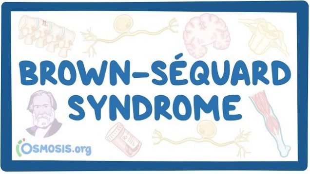 Brown-Séquard syndrome – causes, symptoms, diagnosis, treatment, pathology