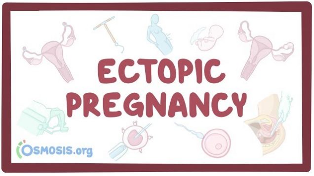 Ectopic pregnancy