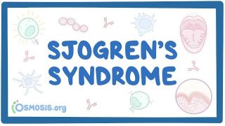Sjogren’s syndrome