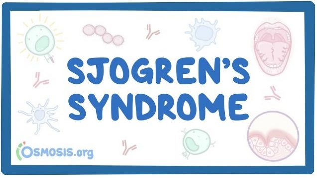 Sjogren’s syndrome