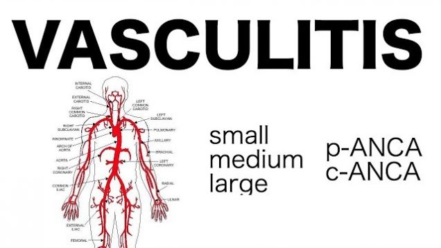 Vasculitis